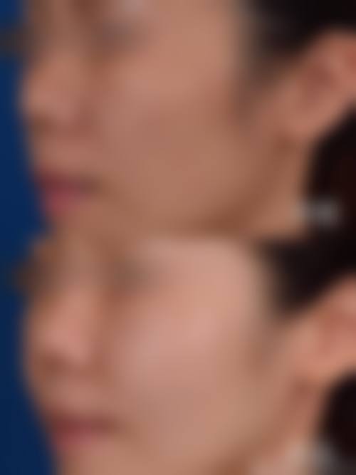 十堰梵媞整形医院怎么样求美者反馈