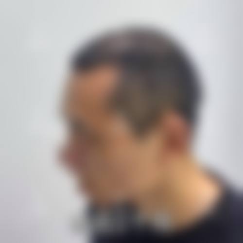 连云港新丝梵植发医疗美容诊所怎么样价格收费