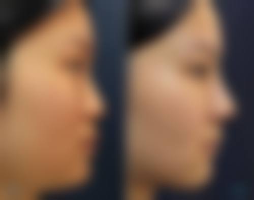 Preecha Tiewtranon医生的眼部整形优势