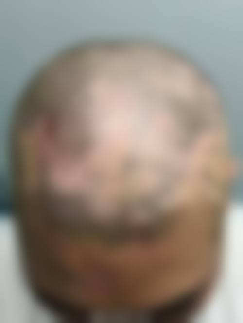 青岛洋美植发特色项目及技术优势