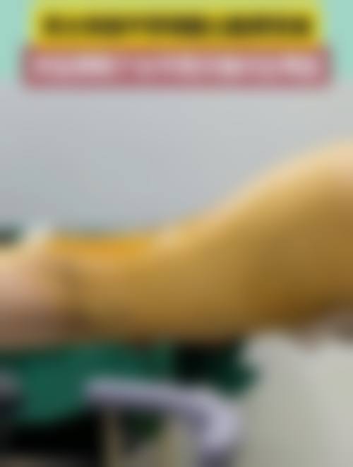 韩国N-Slim吸脂医院求美者反馈