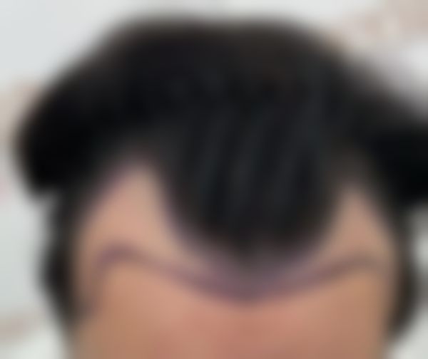 淄博真程植发医院特色项目及技术优势