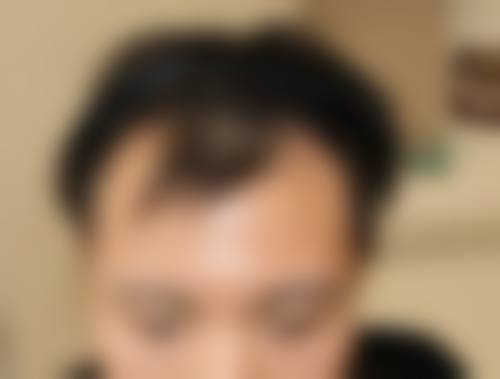 广州新生植发医院求美者反馈