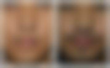 广州新生植发医院价格收费