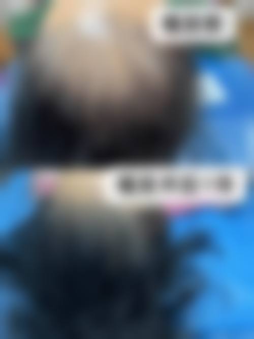 重庆莱森植发门诊部求美者反馈