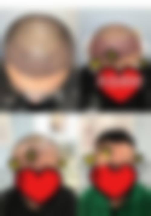 武汉万禾盛无痕植发专科门诊求美者反馈