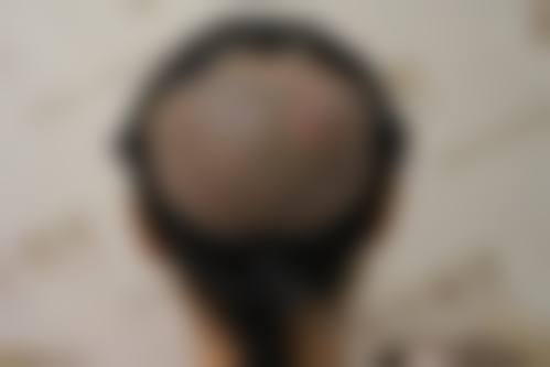 兰州青丝亿植发诊所求美者反馈