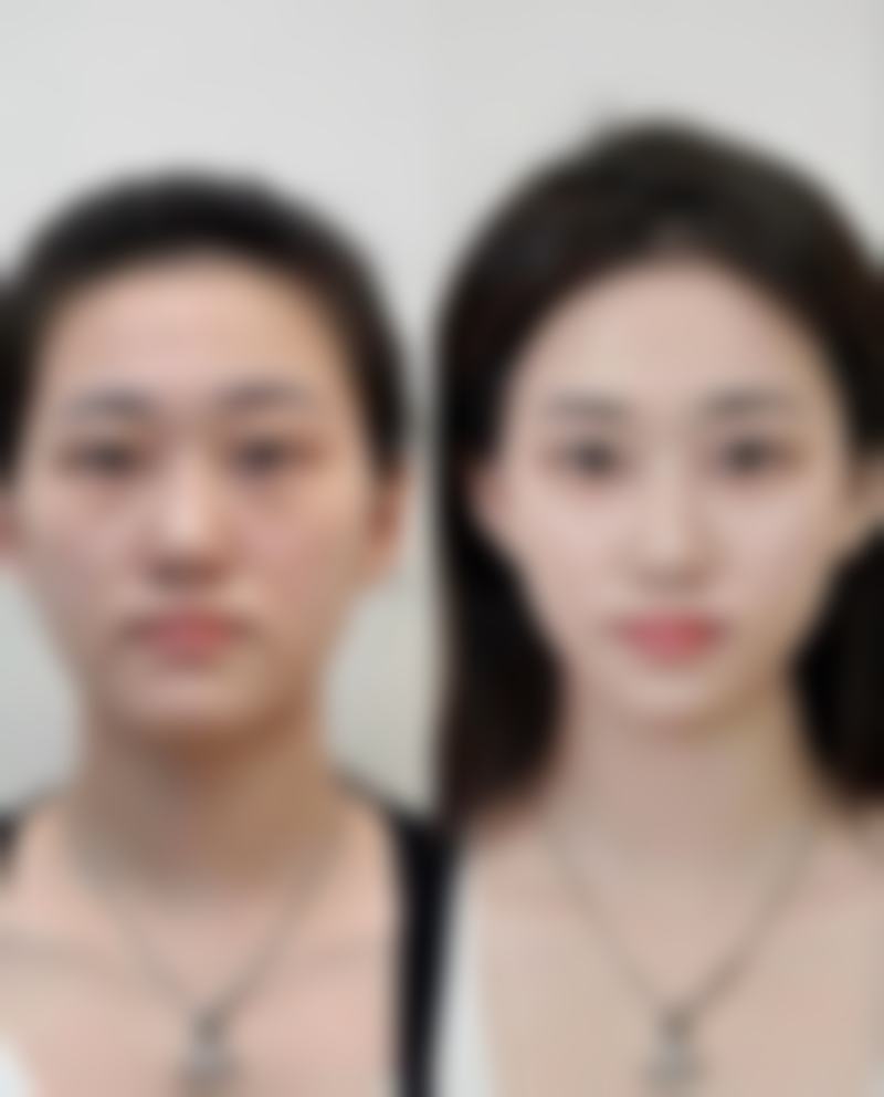 韩国Toptier整形外科价格收费